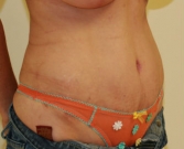 Feel Beautiful - Liposuction Case 8 - After Photo